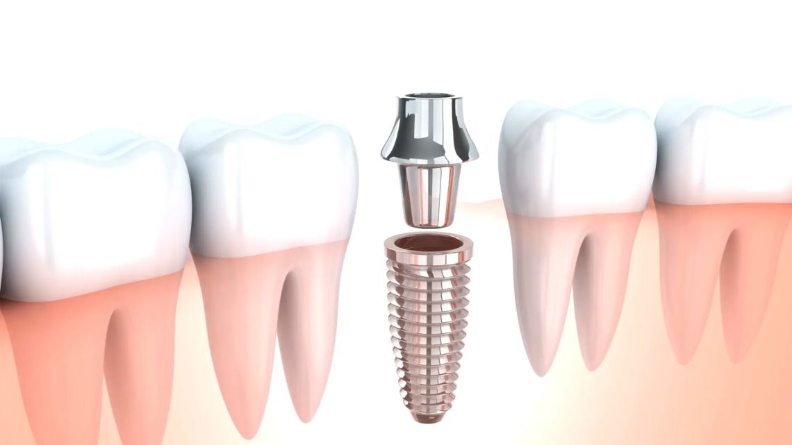 Benefits of Dental Implants