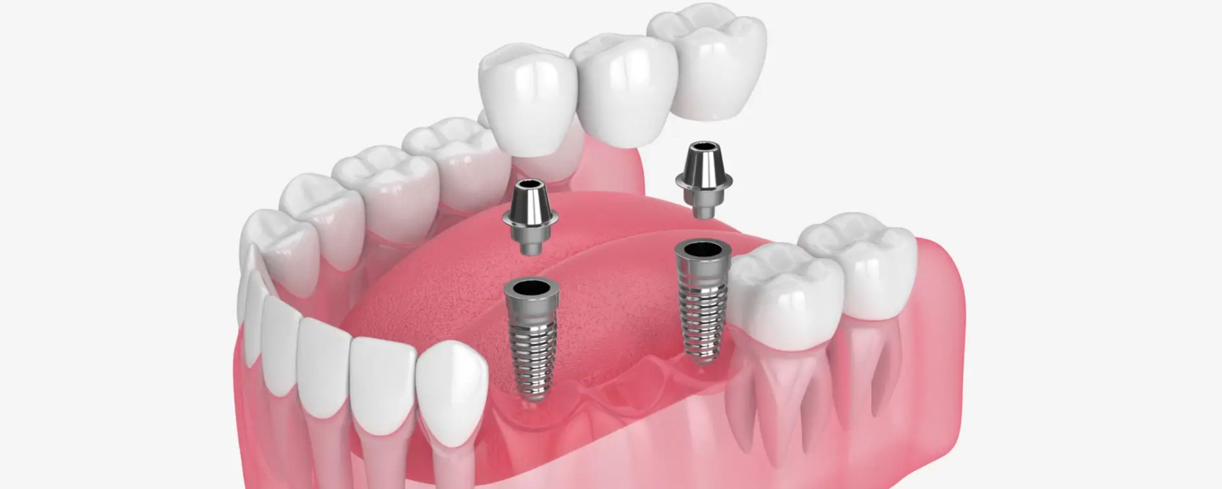 Benefits of Dental Implants