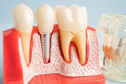 Dead Teeth: Causes, Symptoms and Treatment